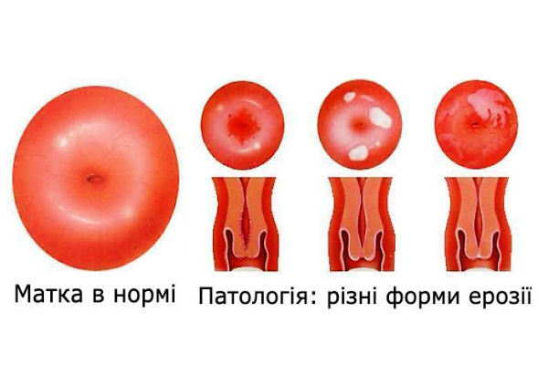 Що таке кольпоскопія, та коли вона потрібна?